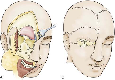 Basic Principles of Skull Base Surgery | Neupsy Key