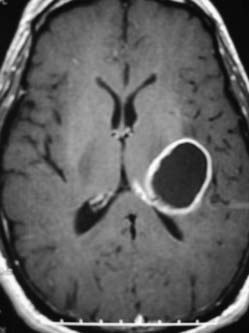 Unusual Gliomas | Neupsy Key