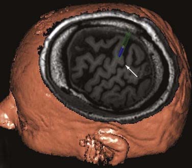 Motor Cortex Stimulation | Neupsy Key