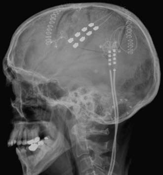 Motor Cortex Stimulation | Neupsy Key