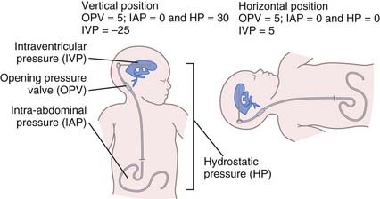 Cerebrospinal Fluid Devices | Neupsy Key