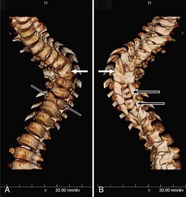 Split Spinal Cord | Neupsy Key