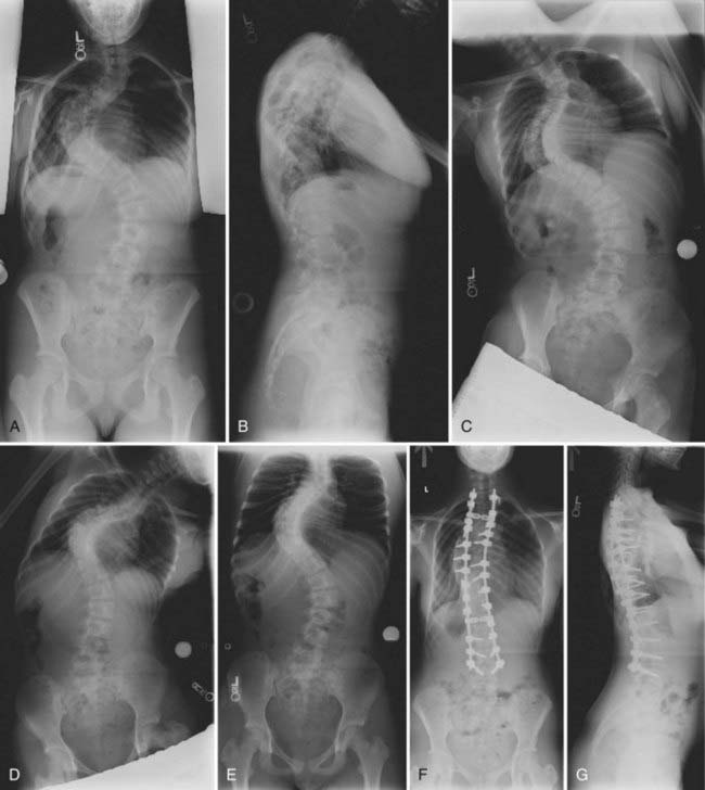 Thoracolumbar Spinal Disorders In Pediatric Patients | Neupsy Key