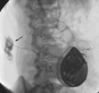 Intrathecal Baclofen Therapy For Cerebral Palsy | Neupsy Key