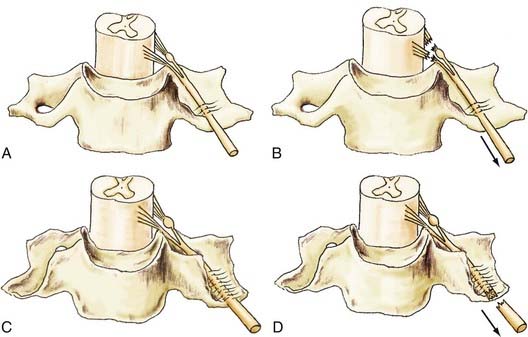 Pathophysiology of Surgical Nerve Disorders | Neupsy Key