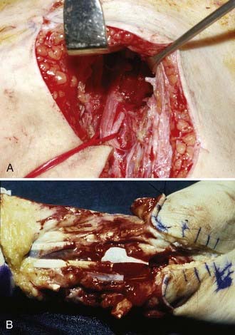 Management of Acute Peripheral Nerve Injuries | Neupsy Key