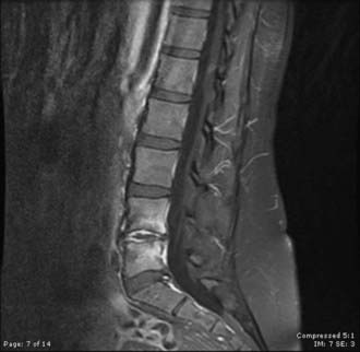 Infections of the Spine | Neupsy Key