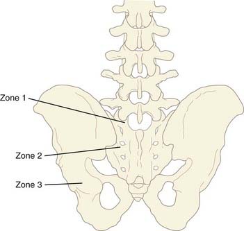 Spinopelvic Fixation | Neupsy Key