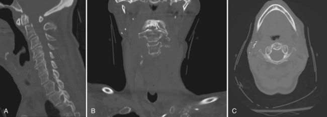 Evaluation And Treatment Of Odontoid And Hangman’s Fractures Neupsy Key