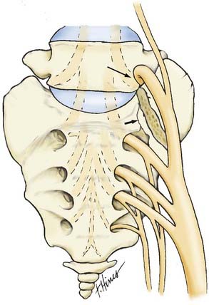 Sacral Fractures | Neupsy Key