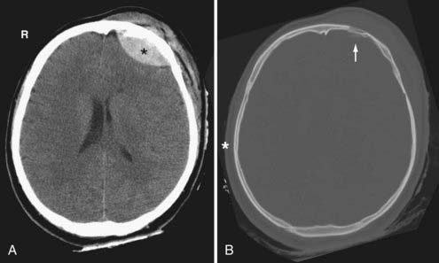 Acute Contusion Scalp