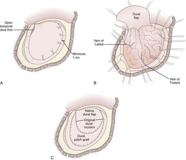 Indications and Techniques for Cranial Decompression after Traumatic ...