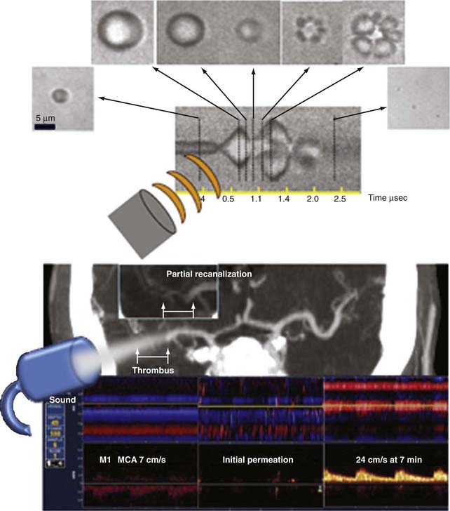 Transcranial Doppler Ultrasonography And Neurosonology | Neupsy Key