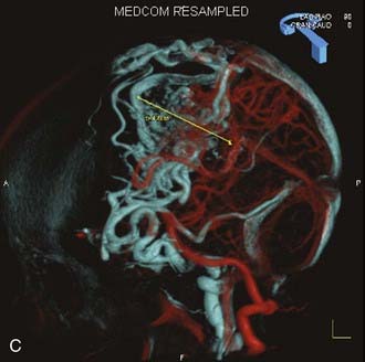 Surgical and Radiosurgical Management of Giant Arteriovenous ...