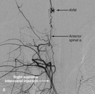 Endovascular Management Of Spinal Vascular Malformations History And