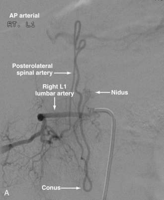 Endovascular Management Of Spinal Vascular Malformations History And