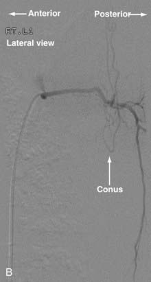 Endovascular Management Of Spinal Vascular Malformations History And