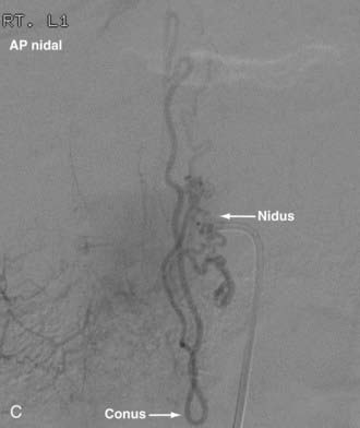 Endovascular Management Of Spinal Vascular Malformations History And