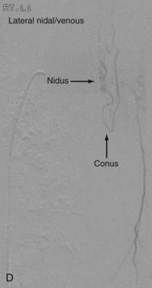 Endovascular Management Of Spinal Vascular Malformations History And