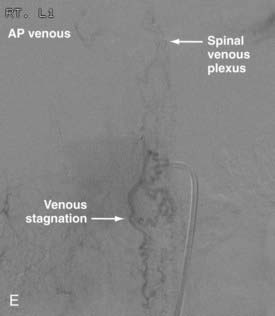 Endovascular Management Of Spinal Vascular Malformations History And