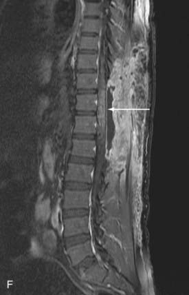 Endovascular Management Of Spinal Vascular Malformations History And