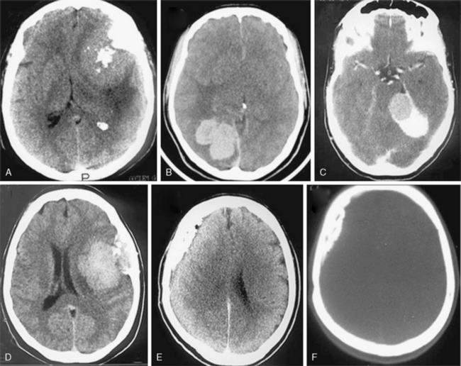 CT Evaluation Of Meningiomas | Neupsy Key