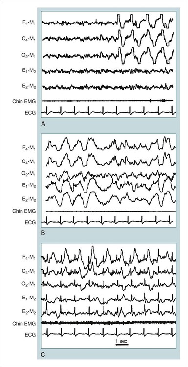 Biocalibration, Artifacts, And Common Variants Of Sleep | Neupsy Key