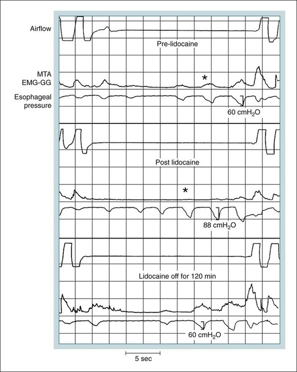 Pathophysiology of Obstructive Sleep Apnea | Neupsy Key