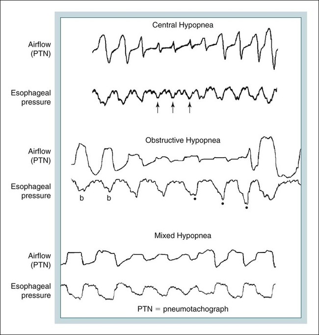 Congenital central hypoventilation syndrome что это