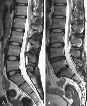 Causes of Premature Aging of the Spine | Neupsy Key