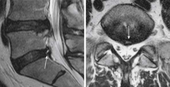 Imaging of the Aging Spine | Neupsy Key