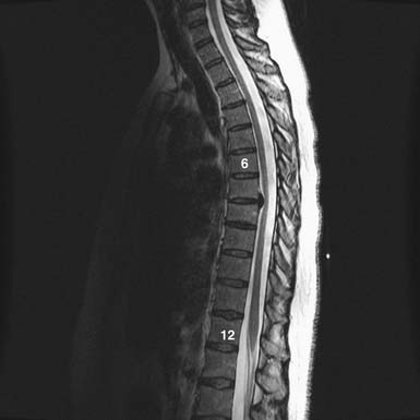 Thoracic Spinal Stenosis | Neupsy Key