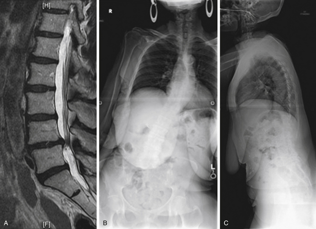 Pre-operative plain radiograph of Dorso-lumbar spine in (1A)