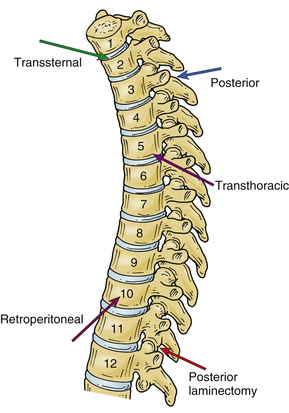 Extraspinal Anatomy and Surgical Approaches to the Thoracic Spine ...