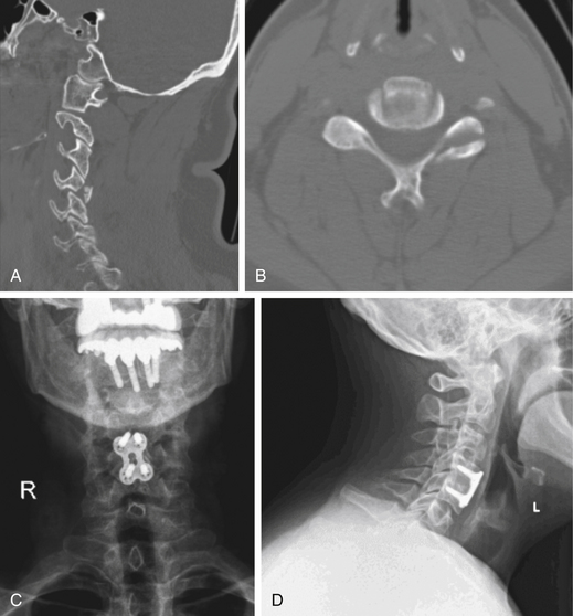 Subaxial Cervical Spine Injuries | Neupsy Key