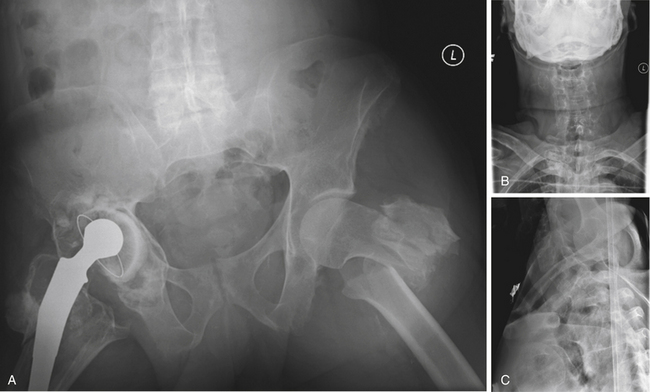 Nonoperative Management And Treatment Of Spine Injuries Neupsy Key 7068