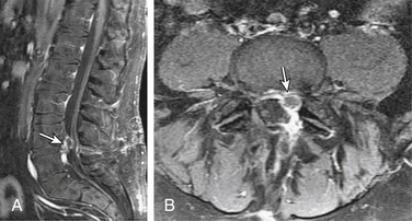 Recurrent Lumbar Disc Herniation | Neupsy Key