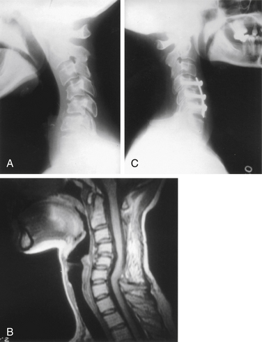 Subaxial Cervical Deformities | Neupsy Key