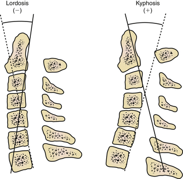 kyphotic cervical spine
