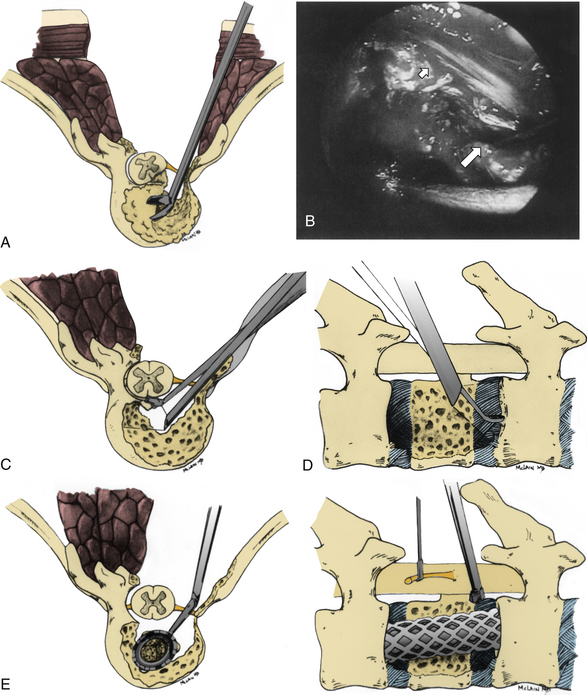 Minimally Invasive Spinal Decompression And Stabilization Techniques II ...