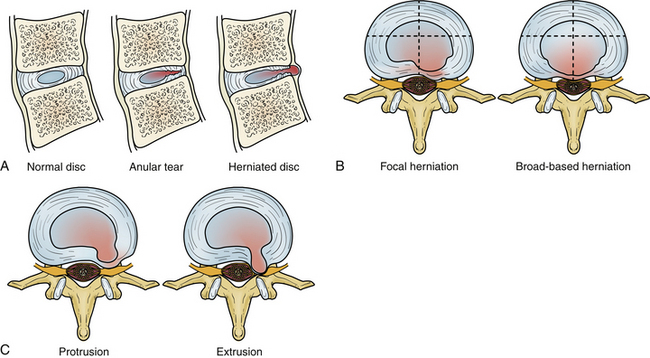 Degenerative Disease and Infection: Role of Imaging | Neupsy Key