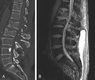 Management of a Patient with Thoracolumbar Fracture with Complete ...