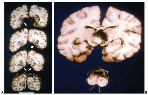 Neuropathology Of Brain Trauma In Infants And Children | Neupsy Key