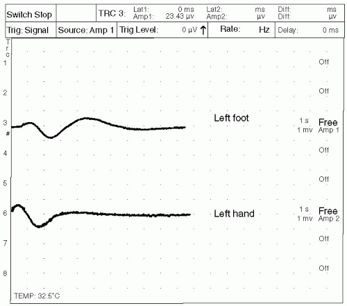 General Principles Of Electromyography | Neupsy Key