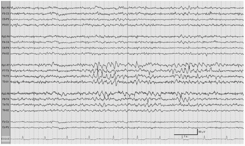 Adult Electroencephalography | Neupsy Key