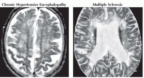 confluent-white-matter-lesions-neupsy-key