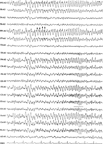 Ictal Electroencephalogram | Neupsy Key