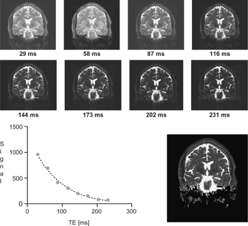 Structural Neuroimaging | Neupsy Key