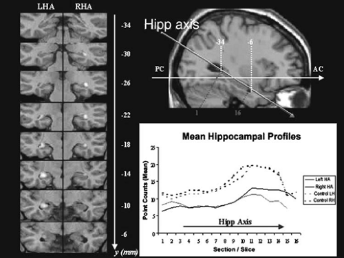 Structural Neuroimaging | Neupsy Key