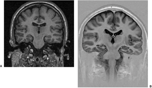 Structural Neuroimaging | Neupsy Key